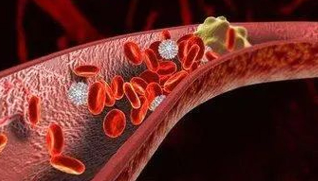 深靜脈血栓防治之流水不腐，戶樞不蠹