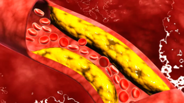 年度回眸、精彩擷萃丨2022年靜脈血栓防治領(lǐng)域十件大事