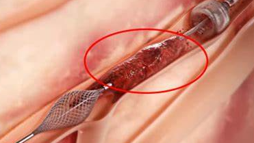 已形成深靜脈血栓者治療措施及研究進展