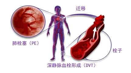 骨科術后重點關注的問題—VTE，該如何防治？