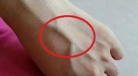 有人手臂上“青筋暴起”，有人卻看不到“青筋”，這是咋回事？
