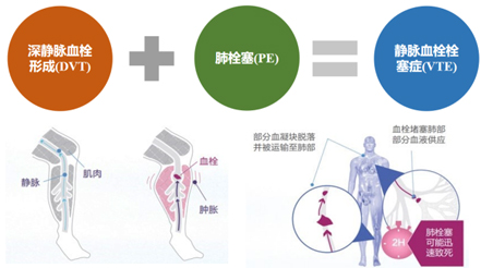 躺著也能防血栓？神經(jīng)肌肉電刺激來幫忙