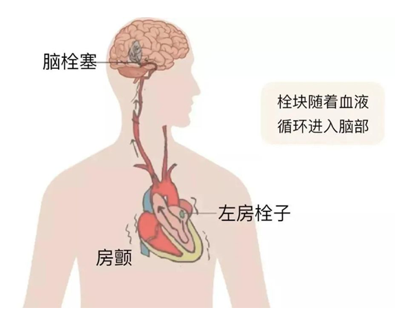血栓是心梗、腦梗的元兇，很容易找上這些人