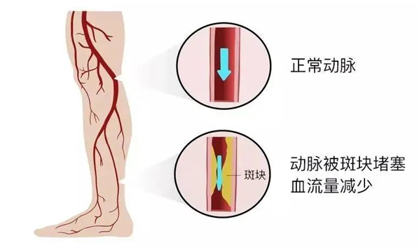 血栓是心梗、腦梗的元兇，很容易找上這些人