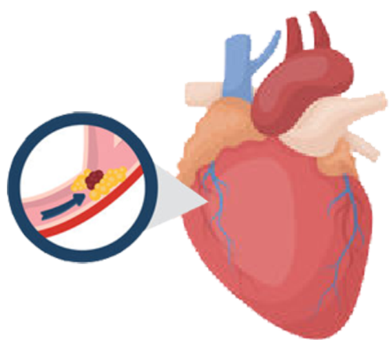 血栓是心梗、腦梗的元兇，很容易找上這些人