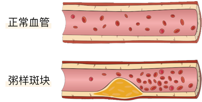 血栓是心梗、腦梗的元兇，很容易找上這些人