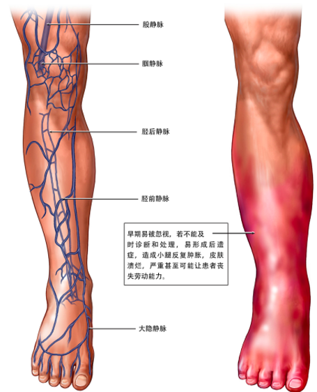 警惕！這個全球“第三大心血管殺手”，我們該如何應(yīng)對？