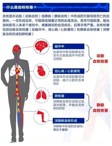 2022世界血栓日：就醫(yī)有新路，血栓找介入