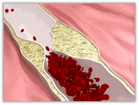 讓我們一起來了解產(chǎn)后媽媽VTE的預(yù)防