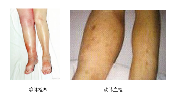 動(dòng)脈血栓和靜脈血栓有什么區(qū)別嗎？