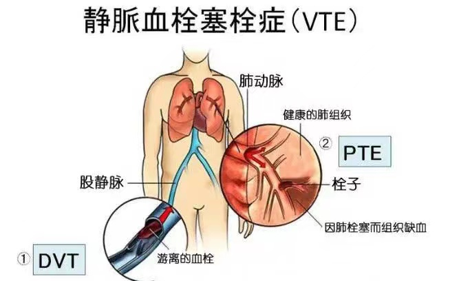 哪些人容易發(fā)生靜脈血栓栓塞癥(VTE) 哪些人容易發(fā)生靜脈血栓栓塞癥(VTE)
