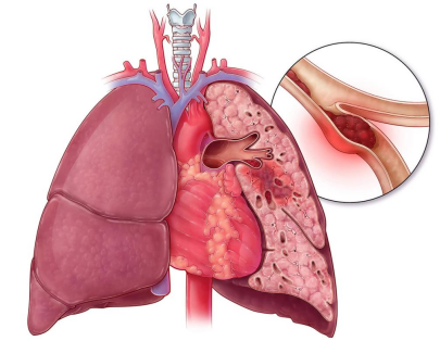 “沉默殺手”肺栓塞(上) “沉默殺手”肺栓塞(上)