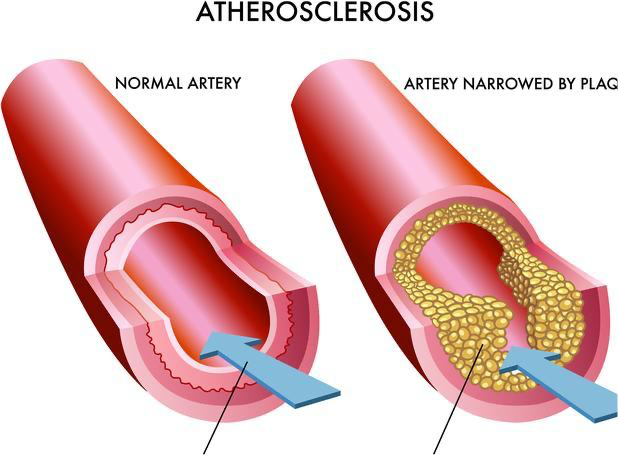 老年人如何預(yù)防下肢靜脈血栓 哪些癥狀提示下肢靜脈有血栓了 老年人如何預(yù)防下肢靜脈血栓 哪些癥狀提示下肢靜脈有血栓了