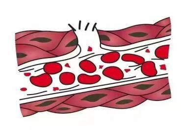 老年人如何預(yù)防下肢靜脈血栓 哪些癥狀提示下肢靜脈有血栓了 老年人如何預(yù)防下肢靜脈血栓 哪些癥狀提示下肢靜脈有血栓了