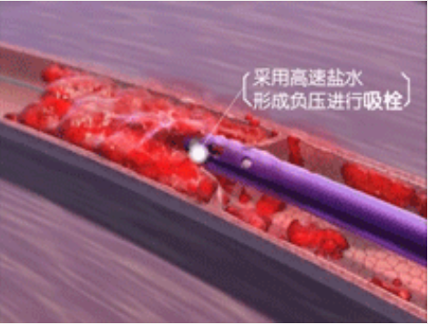 深靜脈血栓能致命，防治“大法”要了解！