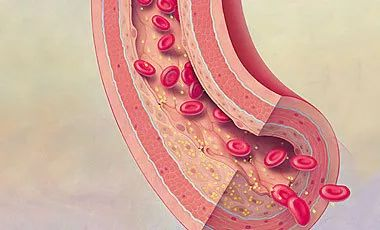 血栓形成，三個要素細(xì)分說