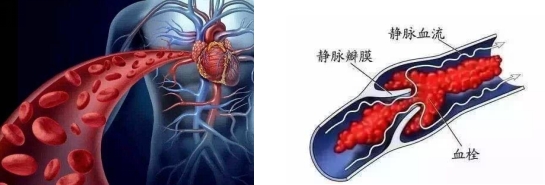 妊娠過(guò)程中的“潛伏殺手”——易栓癥 妊娠過(guò)程中的“潛伏殺手”——易栓癥