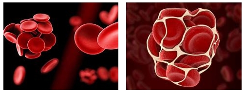 妊娠過(guò)程中的“潛伏殺手”——易栓癥 妊娠過(guò)程中的“潛伏殺手”——易栓癥