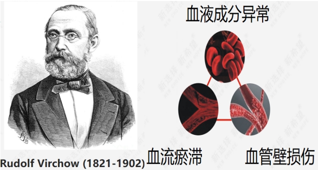 深靜脈血栓（VTE）的前世——血栓形成的三大危險因素