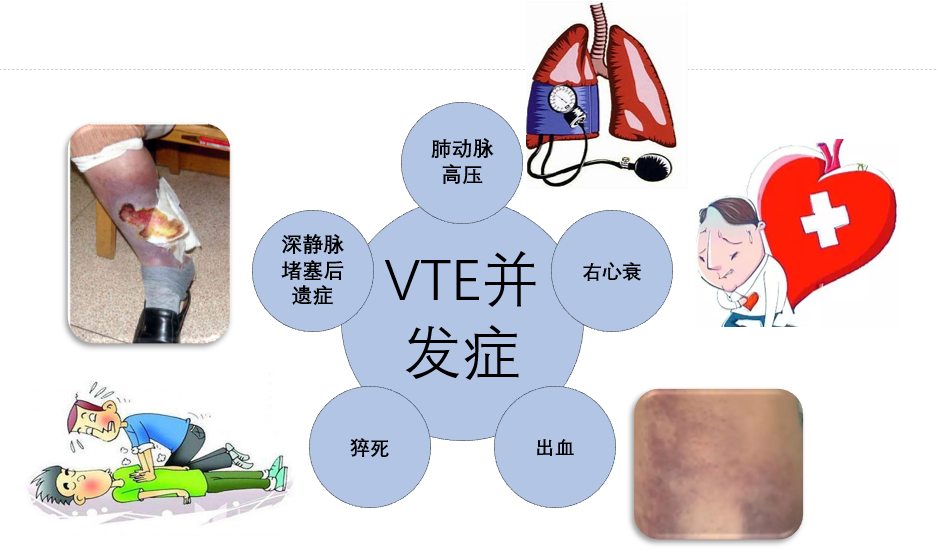 VTE的危害您了解嗎？