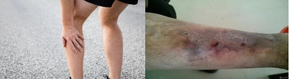 淺談深靜脈血栓后綜合征(PTS) 淺談深靜脈血栓后綜合征(PTS)