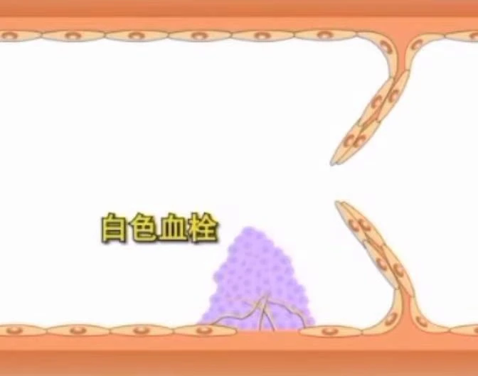 世界血栓日來(lái)臨之際 共話(huà)血栓的前世今生