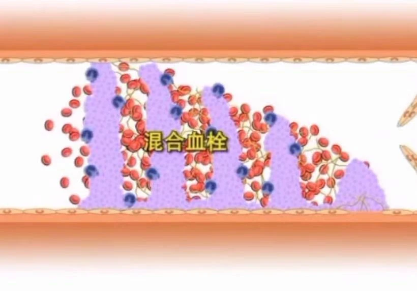 世界血栓日來(lái)臨之際 共話(huà)血栓的前世今生