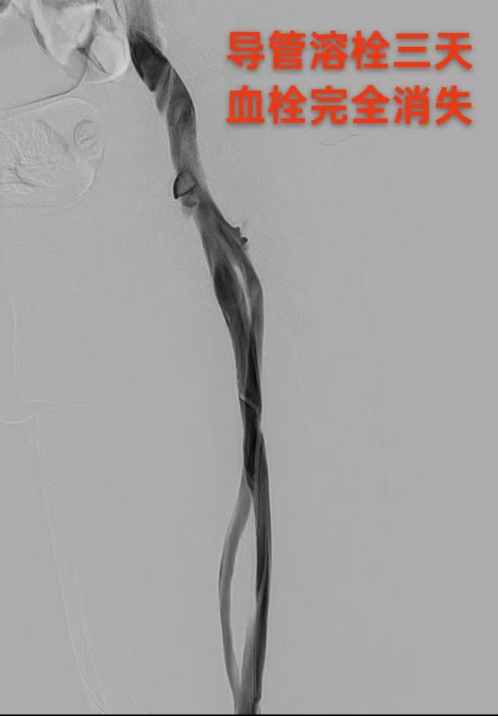 血栓的歸處 血栓的歸處